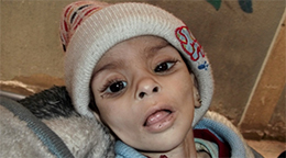 //Israa al-Masri, a Palestinian baby who died of hunger-related illness on Jan. 11, 2014 in Yarmouk