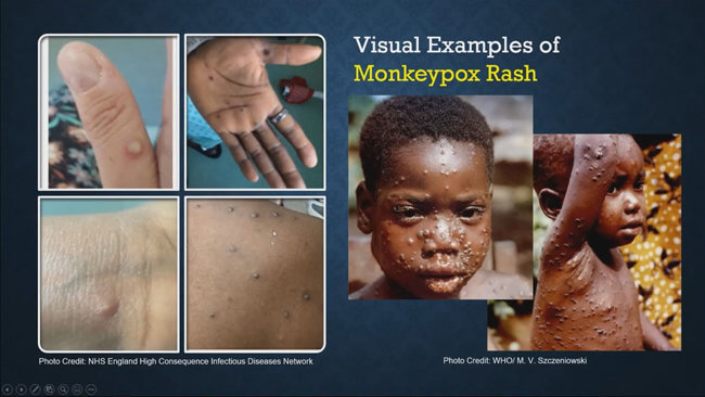 Les Pratiques essentielles pour freiner la propagation de la Monkeypox | REPONGAC - Réseau des Plate-formes des ONG de l'Afrique Centrale